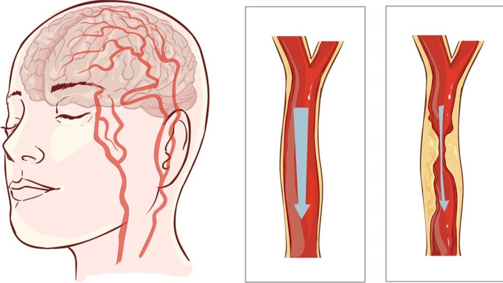 Evite un ataque al corazón o un derrame cerebral: 8 hábitos que nunca debe ignorar