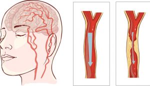 Evite un ataque al corazón o un derrame cerebral: 8 hábitos que nunca debe ignorar