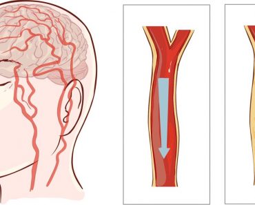 Evite un ataque al corazón o un derrame cerebral: 8 hábitos que nunca debe ignorar