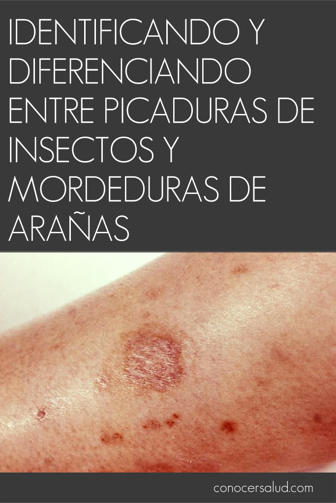 Identificando y diferenciando entre picaduras de insectos y mordeduras de arañas