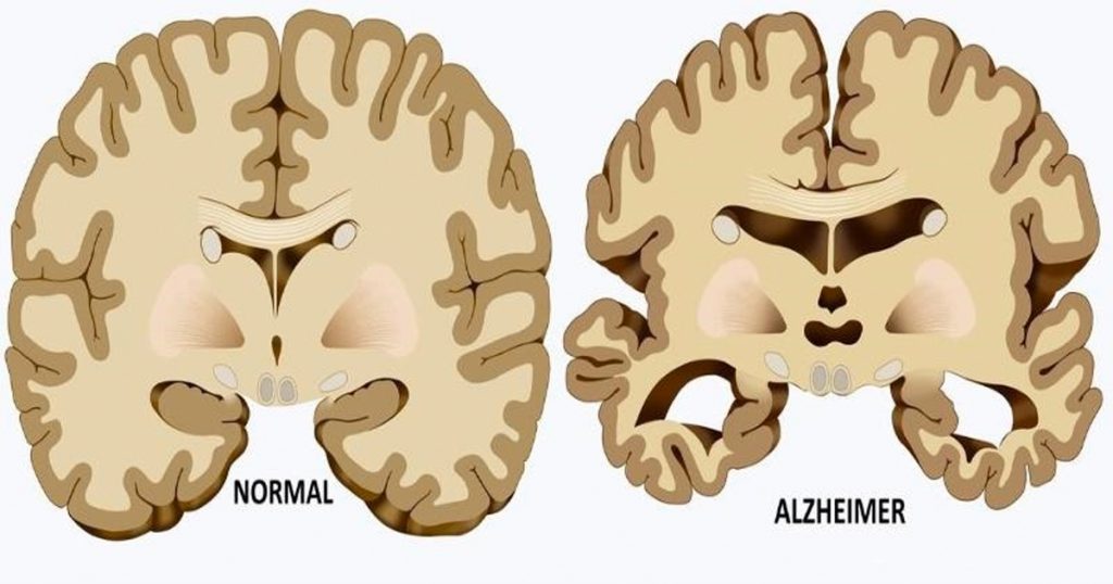 5 Causas ocultas de la enfermedad de Alzheimer que la mayoría de las personas no conocen