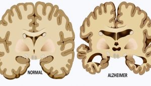 5 Causas ocultas de la enfermedad de Alzheimer que la mayoría de las personas no conocen