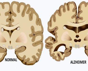 5 Causas ocultas de la enfermedad de Alzheimer que la mayoría de las personas no conocen
