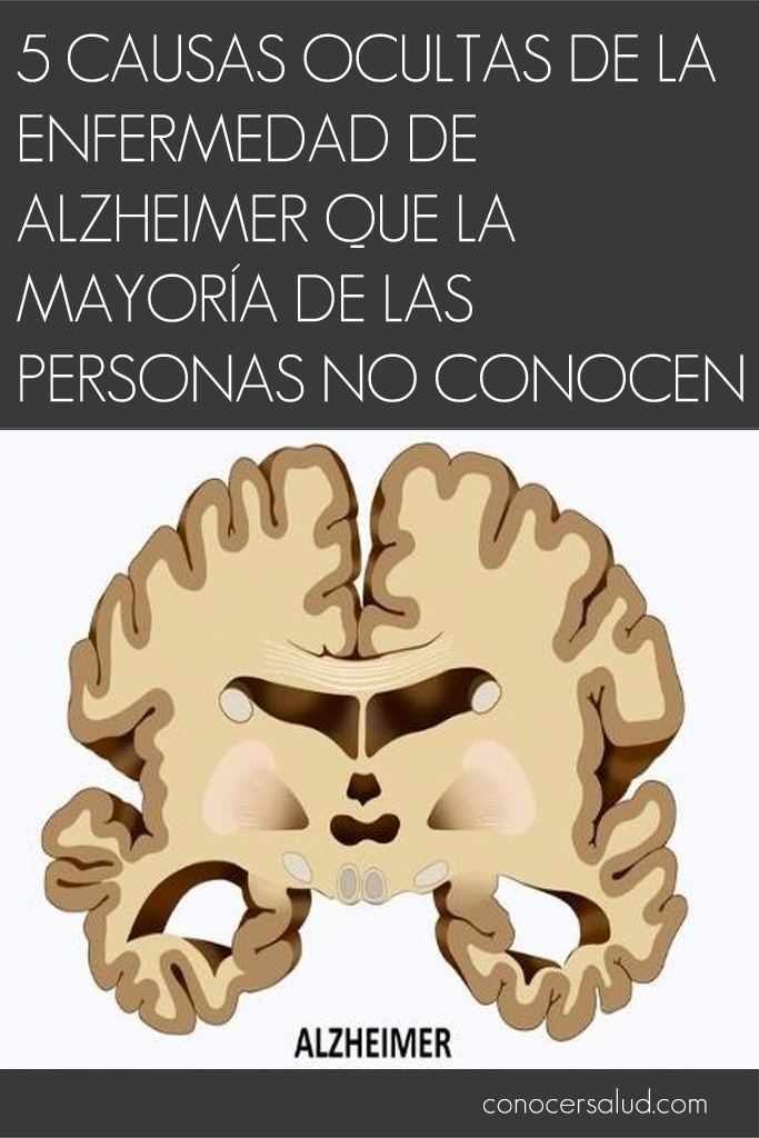 5 Causas ocultas de la enfermedad de Alzheimer que la mayoría de las personas no conocen