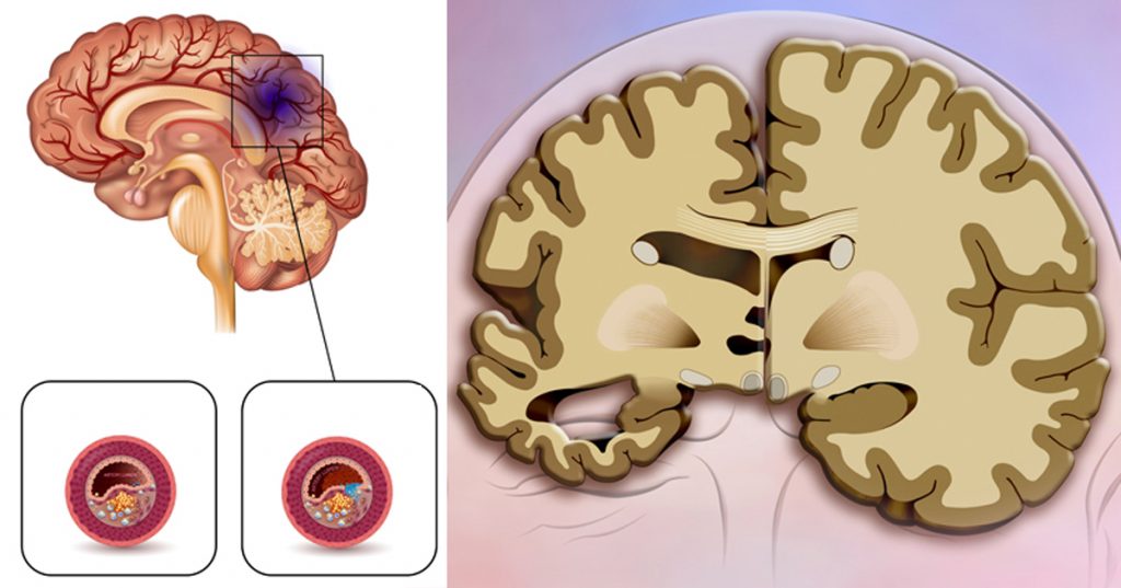 Un nuevo estudio halla que esta popular bebida triplica el riesgo de accidente cerebrovascular y demencia