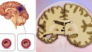 Un nuevo estudio halla que esta popular bebida triplica el riesgo de accidente cerebrovascular y demencia