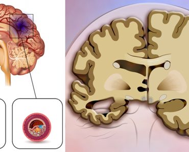 Un nuevo estudio halla que esta popular bebida triplica el riesgo de accidente cerebrovascular y demencia