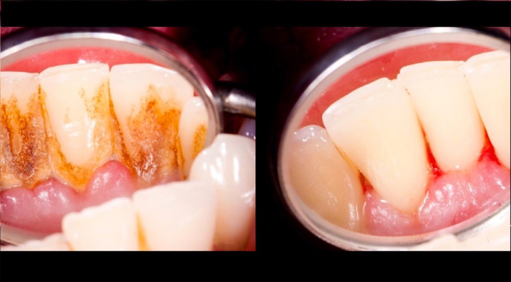 4 mezclas que eliminan completamente el sarro de los dientes