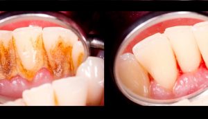 4 mezclas que eliminan completamente el sarro de los dientes