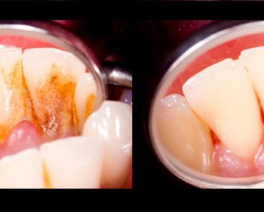 4 mezclas que eliminan completamente el sarro de los dientes