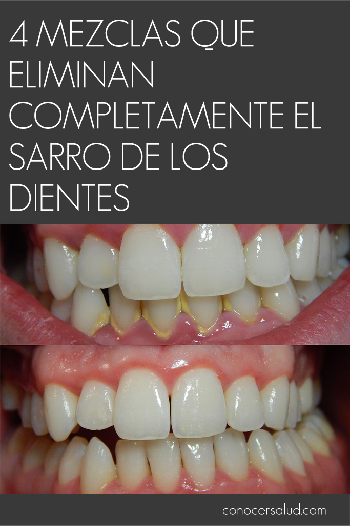 4 mezclas que eliminan completamente el sarro de los dientes