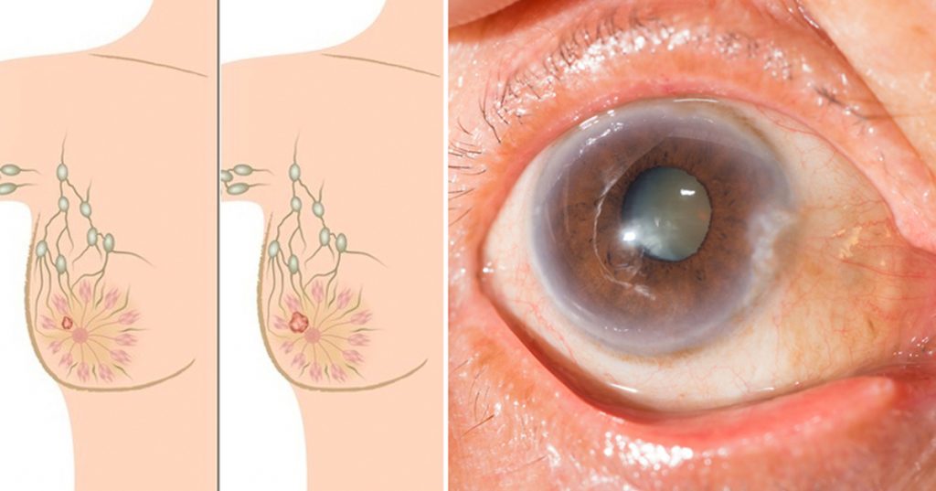 Relacionan éste medicamento común con cáncer, cataratas y enfermedad de Alzheimer