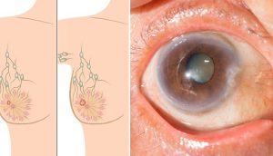 Relacionan éste medicamento común con cáncer, cataratas y enfermedad de Alzheimer