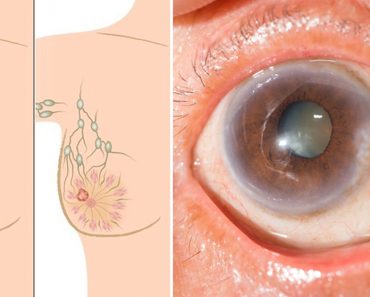 Relacionan éste medicamento común con cáncer, cataratas y enfermedad de Alzheimer