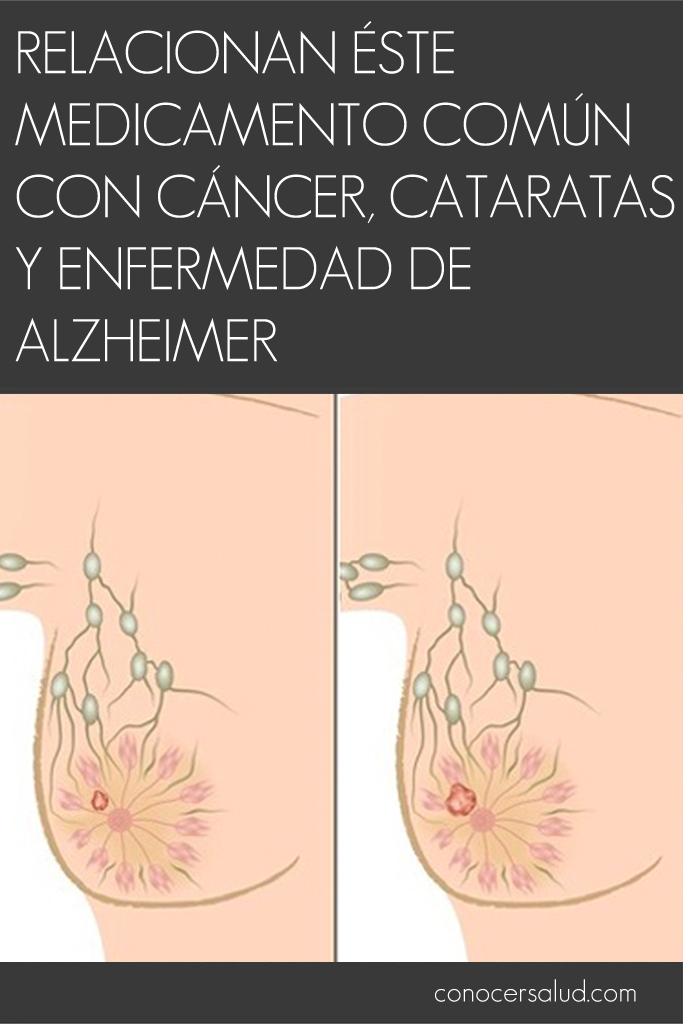 Relacionan éste medicamento común con cáncer, cataratas y enfermedad de Alzheimer