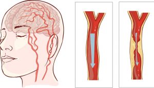 Evite un ataque cardíaco o accidente cerebrovascular: 8 hábitos que nunca debe ignorar