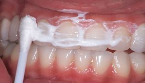 Cómo prevenir la acumulación de sarro, blanquear los dientes y evitar la caries dental en 5 pasos