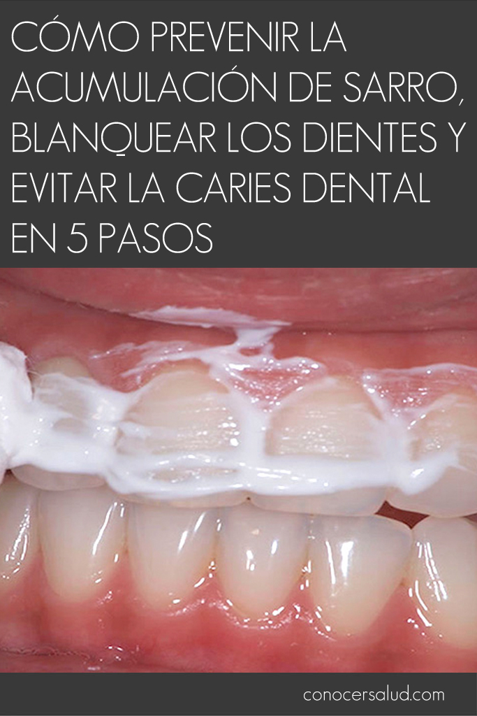 Cómo prevenir la acumulación de sarro, blanquear los dientes y evitar la caries dental en 5 pasos