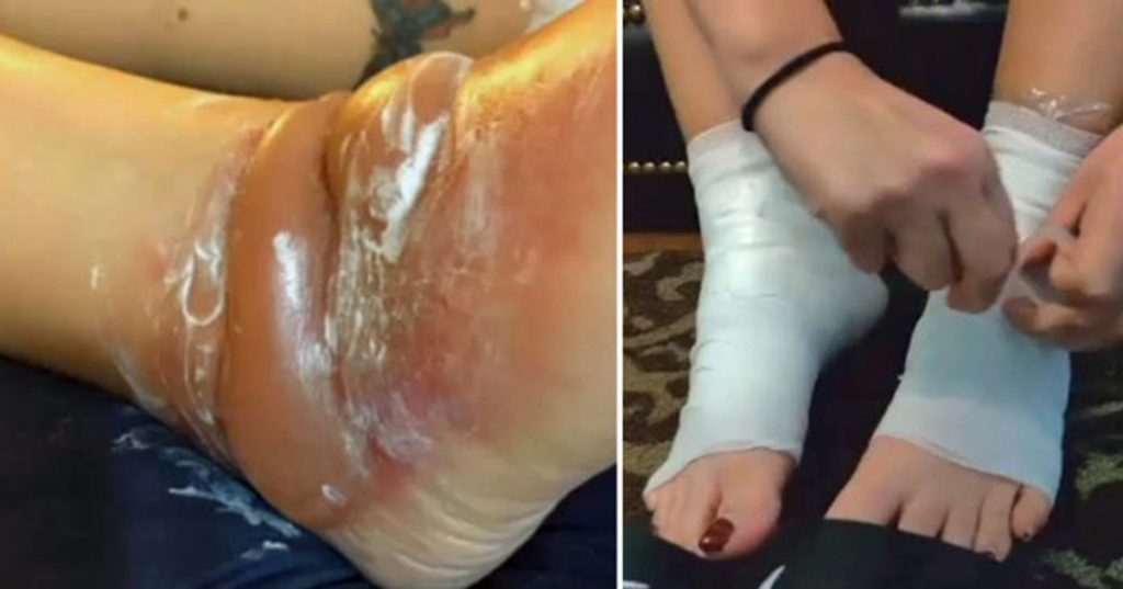 Esta madre casi pierde los pies después de usar este popular calzado