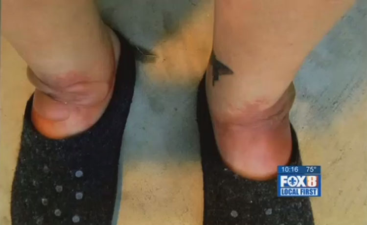 Esta madre casi pierde los pies después de usar este popular calzado