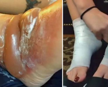 Esta madre casi pierde los pies después de usar este popular calzado