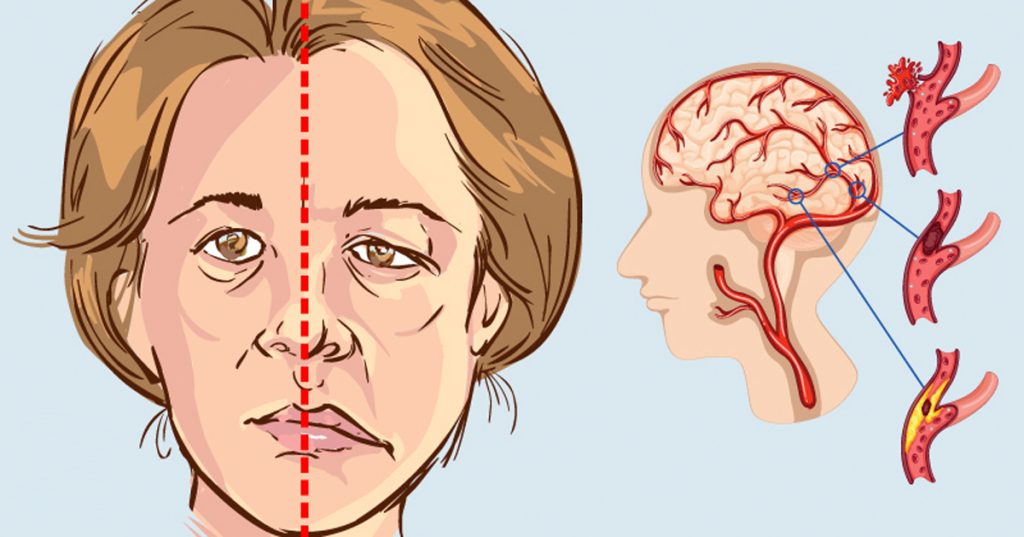 Mujer: Cómo saber si le va a dar un derrame cerebral días antes de que suceda