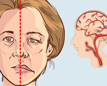 Mujer: Cómo saber si le va a dar un derrame cerebral días antes de que suceda
