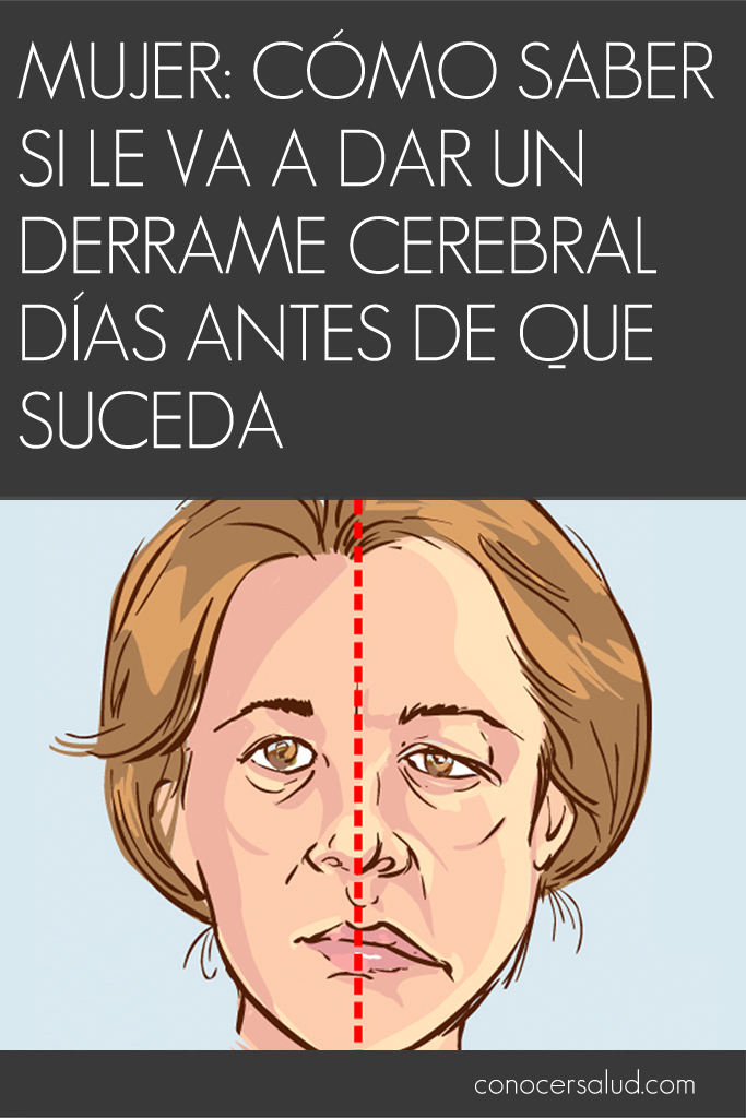 Mujer: Cómo saber si le va a dar un derrame cerebral días antes de que suceda