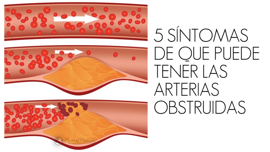 5 síntomas de que puede tener las arterias obstruidas