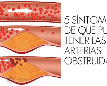 5 síntomas de que puede tener las arterias obstruidas