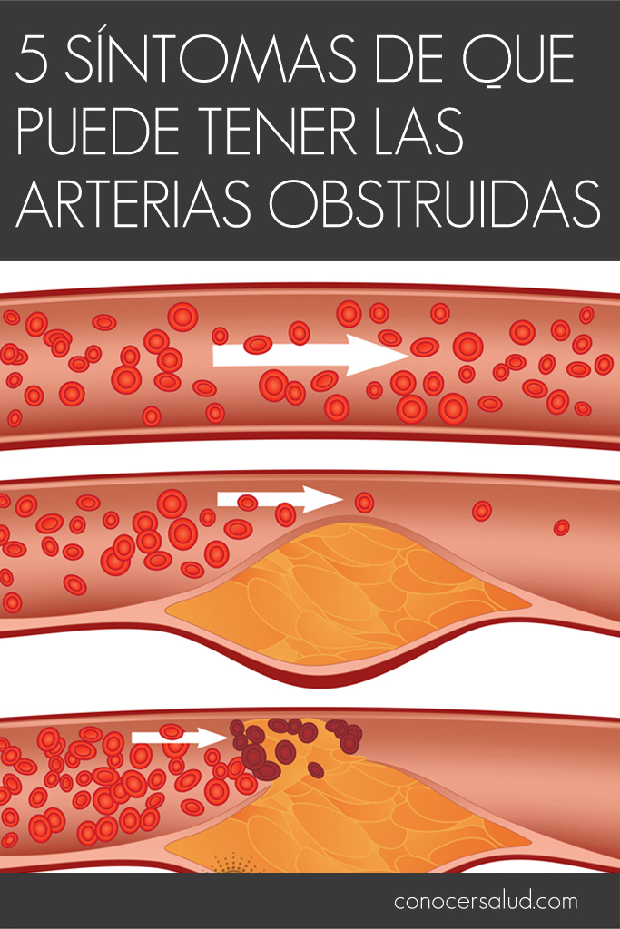 5 síntomas de que puede tener las arterias obstruidas