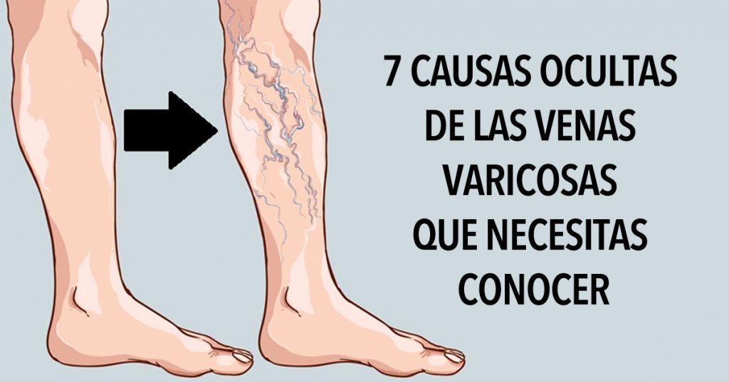 7 causas ocultas de las venas varicosas que necesitas conocer