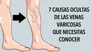 7 causas ocultas de las venas varicosas que necesitas conocer