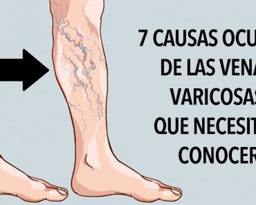 7 causas ocultas de las venas varicosas que necesitas conocer