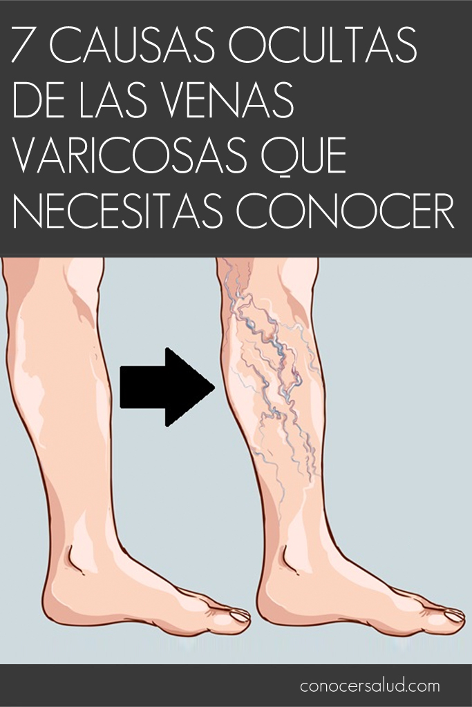 7 causas ocultas de las venas varicosas que necesitas conocer