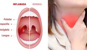 Deshágase de la amigdalitis y dolor de garganta con este rápido remedio casero