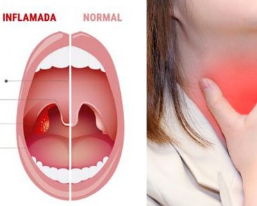 Deshágase de la amigdalitis y dolor de garganta con este rápido remedio casero