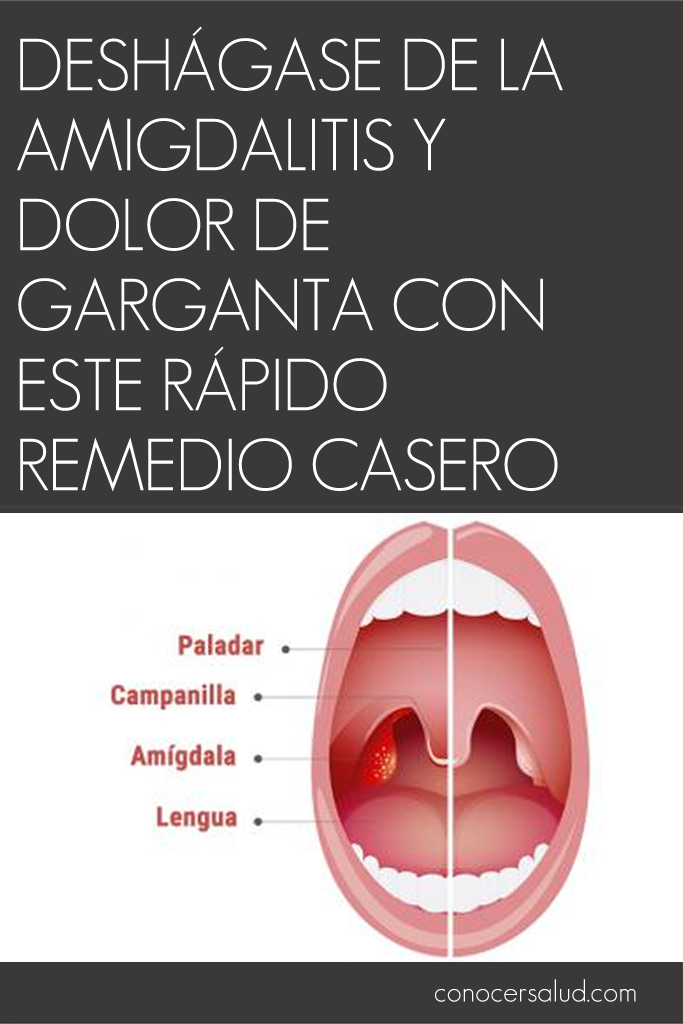 Deshágase de la amigdalitis y dolor de garganta con este rápido remedio casero