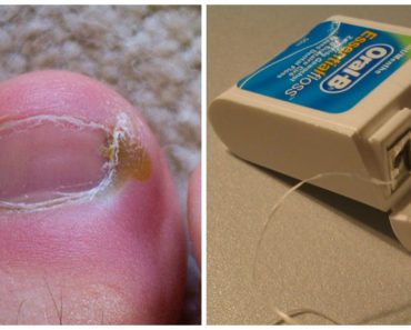 Uñas encarnadas de los pies: 6 Remedios caseros sorprendentemente efectivos