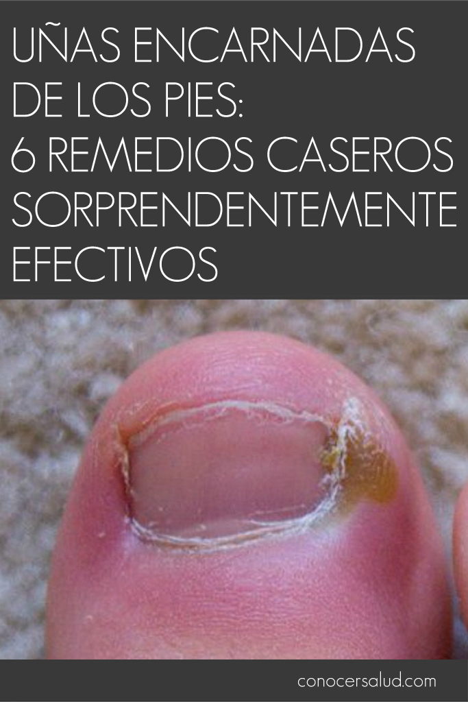 Uñas encarnadas de los pies: 6 Remedios caseros sorprendentemente efectivos