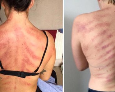 Esta mujer comparte el daño físico que su empleo origina en su espalda