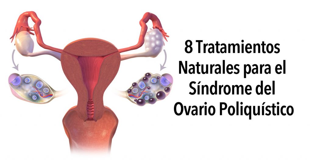 8 Tratamientos naturales para el Síndrome del ovario poliquístico