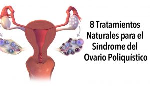 8 Tratamientos naturales para el Síndrome del ovario poliquístico