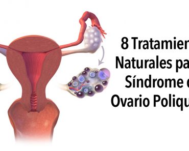 8 Tratamientos naturales para el Síndrome del ovario poliquístico