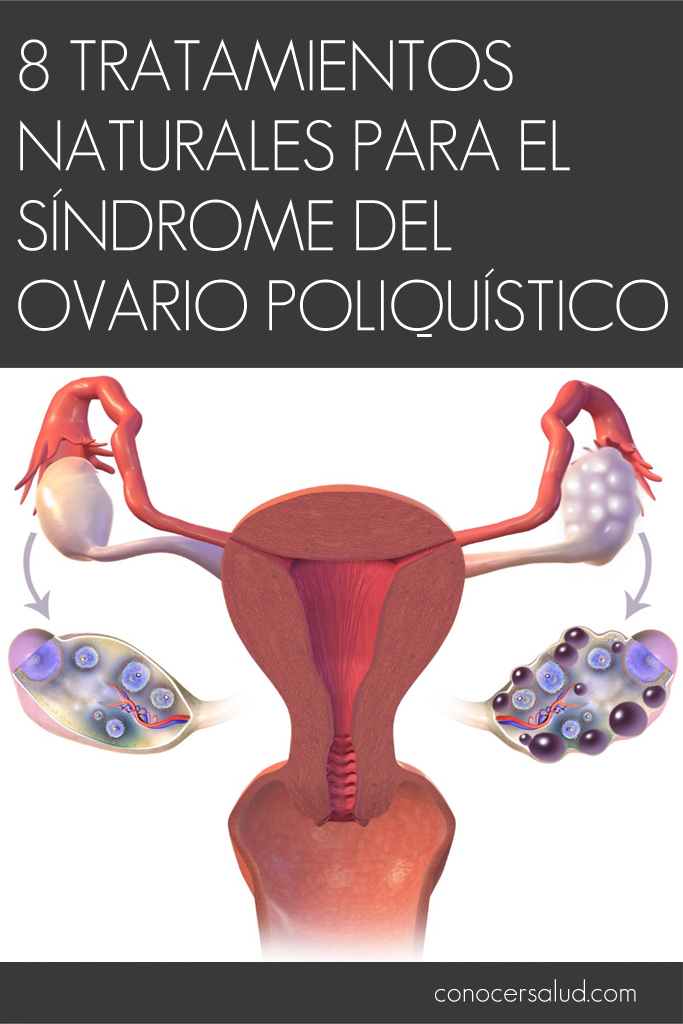 8 Tratamientos naturales para el Síndrome del ovario poliquístico