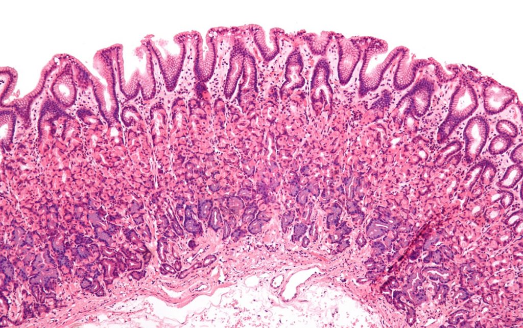 ¿Se relacionan algunos medicamentos para la acidez estomacal con el cáncer de estómago?