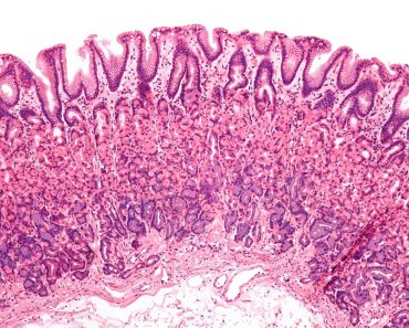 ¿Se relacionan algunos medicamentos para la acidez estomacal con el cáncer de estómago?