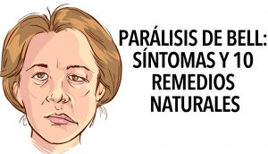 Parálisis De Bell: Síntomas y 10 remedios naturales