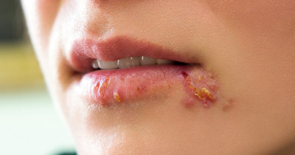 Herpes labial: 10 Remedios caseros