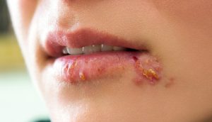 Herpes labial: 10 Remedios caseros